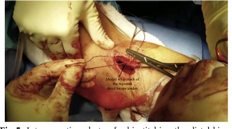 Figure 5 From Anatomic Single Incision Repair Of Distal Biceps Tendon Ruptures Using