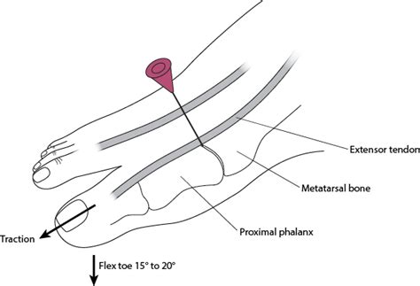 Great Toe Mtp Joint