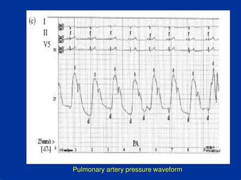 PPT - Cathlab hemodynamics – 1 pressures, waveforms ,cardiac output and ...