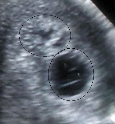 Twins Ultrasound 6 Weeks