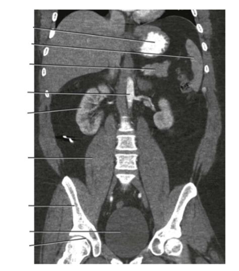 Abdomen Coronal Posterior Diagram Quizlet