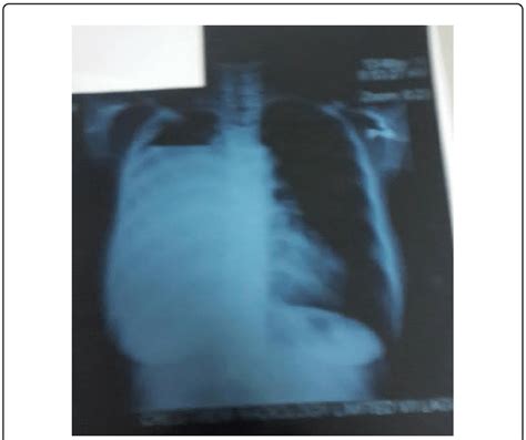 Chest X Ray At Presentation Download Scientific Diagram