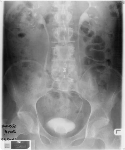 Intravenous Urography Which Was Performed On 28 April 1998 20 Minutes