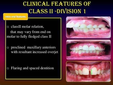 Class Ii Malocclusion