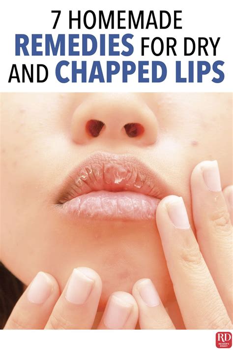 How To Get Rid Of Chapped Lips Fast Artofit