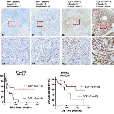 High Sdf 1 Levels Correlate With Poor Prognosis In Nsclc Patients