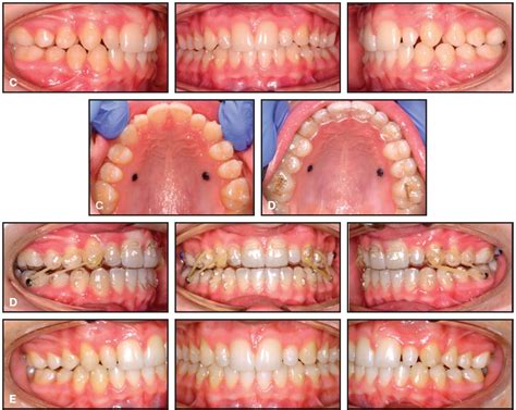 Creative Adjuncts For Clear Aligners Part 1 Class Ii Treatment Jco Online Journal Of