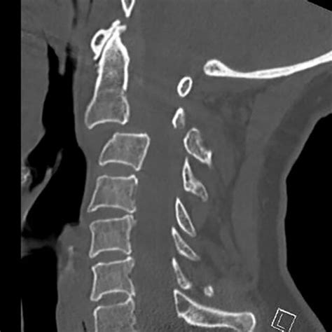 Sagittal Mri Of The Cervical Spine Demonstrating Per Operative Injuries