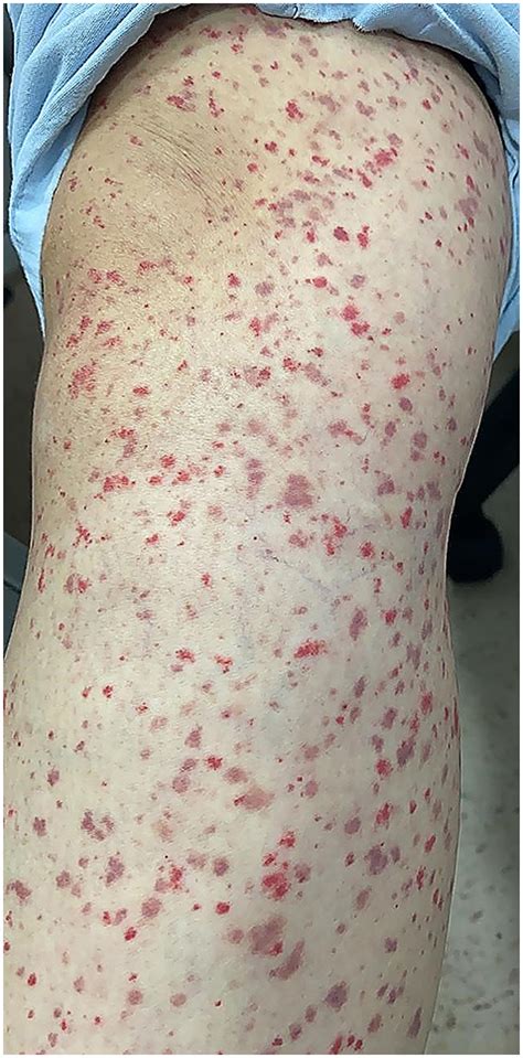 Vasculitis Leucocitocl Stica Asociada A La Vacuna Arnm Contra La Covid