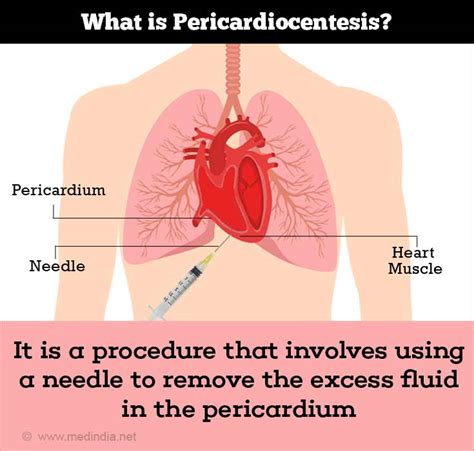 Pericarditis Causes Symptoms And Signs Diagnosis Treatment