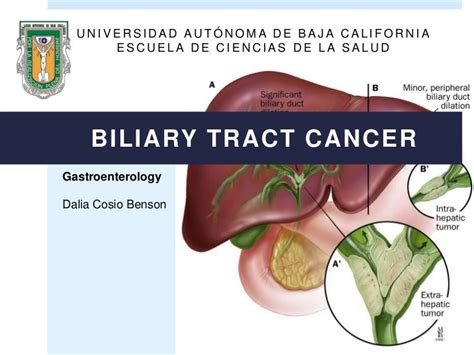 Stages Of Gallbladder Cancer