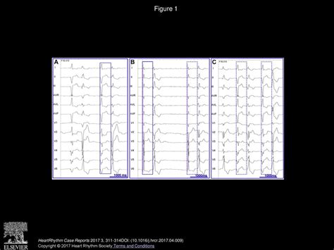 Dual Intraventricular Response After Cardiac Resynchronization Ppt