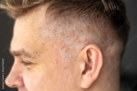 Psoriasis On The Skin Close Up Scalp Photos Of Dermatitis And Eczema