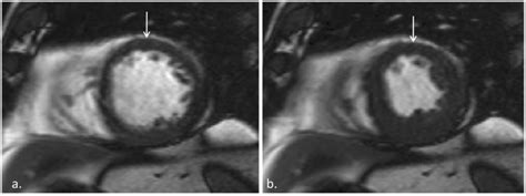 BSSFP Mid Ventricular Short Axis Images At End Diastole A And