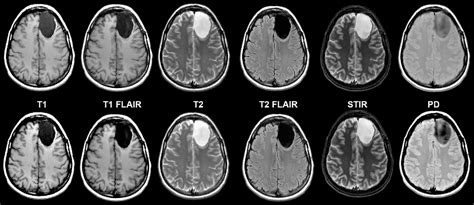 Figure 5 from Synthetic MRI for Clinical Neuroimaging: Results of the ...