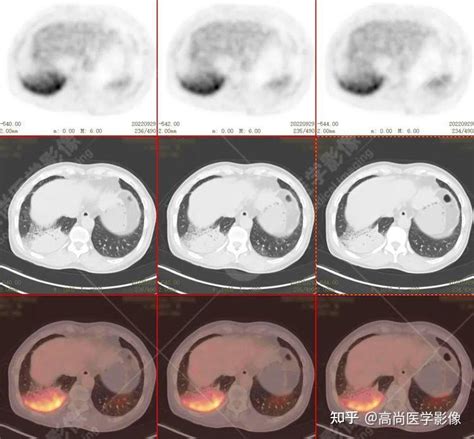 久治不愈的肺炎竟是淋巴瘤，petct显像寻找真凶 知乎