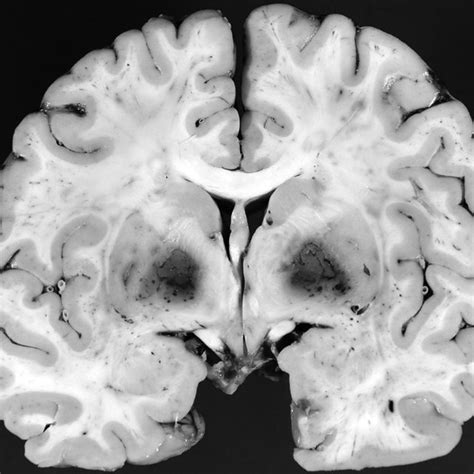 Pdf Bilateral Globus Pallidus Lesions