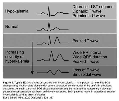 Hyperkalemia Ecg Changes Easy Trick Mechanism Explained Youtube The