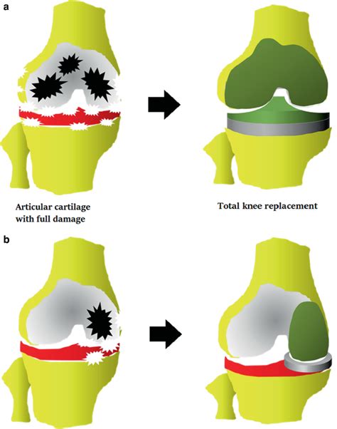 Mimicked Hydrogel Scaffolds For Articular Cartilage Surgery Springerlink