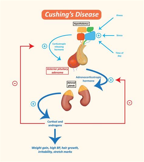 Cushing Syndrome In Children Causes Symptoms And Treatment