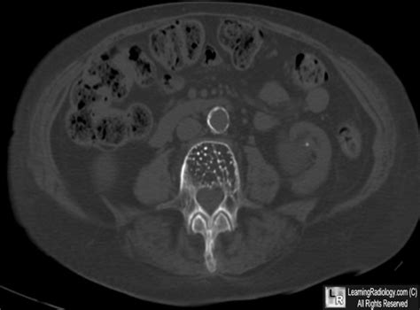 LearningRadiology - Hemangioma, spine, vertebra