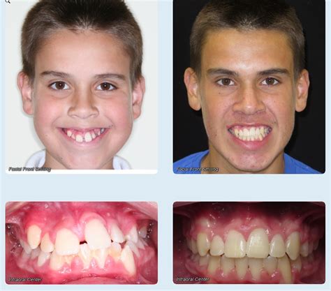 Before and After - Rodriguez Orthodontics | Hialeah FL