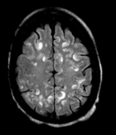 Central nervous system vasculitis | Radiology Reference Article ...