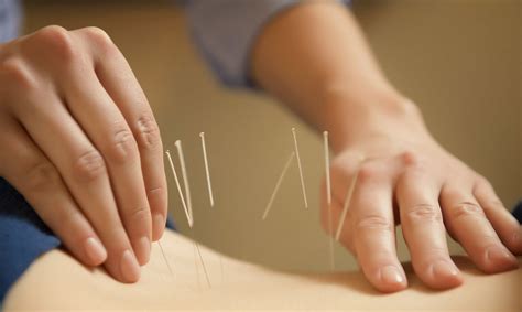 Acupuncture Tallmadge Chiropractic