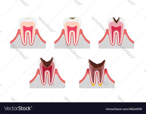 Stages Of Tooth Decay Flat Set Royalty Free Vector Image