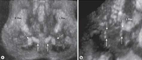 Figure 2 From The Pubic Diastasis Measurement A Key Element For The Diagnosis Management And