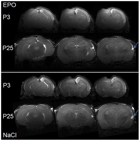 T 2 Weighted MRI At P3 And P25 T 2 Weighted Images Of Typical EPO And