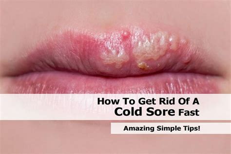 Perfect Tips About How To Get Rid Of A Cold Sore In Few Hours Blockbath71