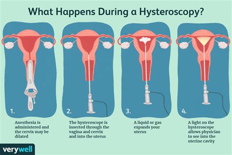 How Do You Prepare For A Hysteroscopy