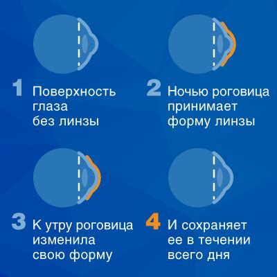 Ортокератология. Ночные линзы для детей