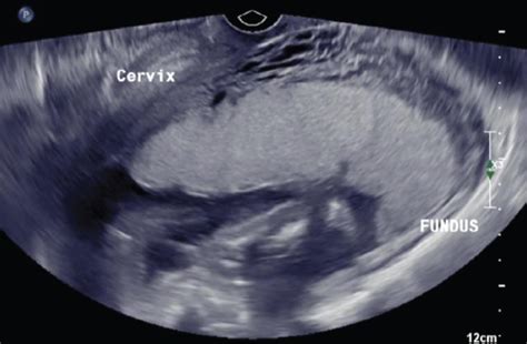 Technique For Minimally Invasive Treatment Of Gestational Uterine