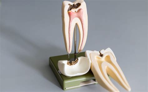 Obturation Techniques Used To Ensure Successful Root Canals