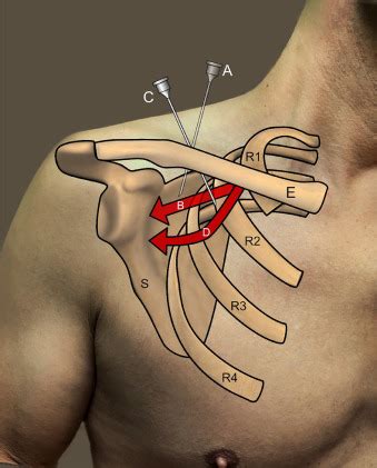 Ultrasound Guided Retroclavicular Approach To The Infraclavicular