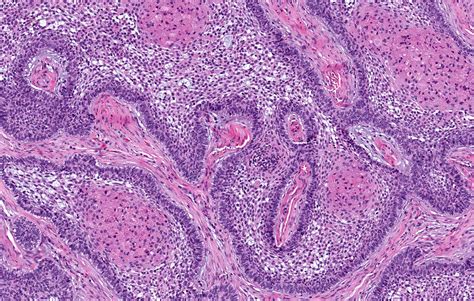 Ameloblastoma Histology