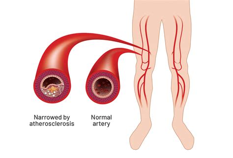 Peripheral Arterial Disease Clinique Pierre Larose