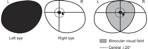 2 Monocular Blindness From Any Cause In This Case In The Left Eye