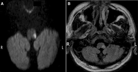 Mri Brain A Axial Dwi And B Flair Show An Acute Left Sided Dorsal