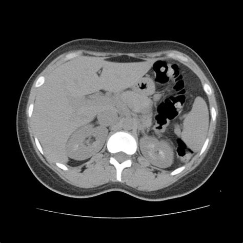 Medullary Sponge Kidney Pictures