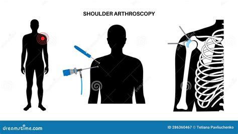 Shoulder Arthroscopy Poster Stock Vector Illustration Of Surgery Inflammation 286360467