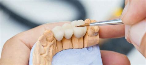 All to know about Full And Partial Dental Bridge | Healing Clinic Turkey