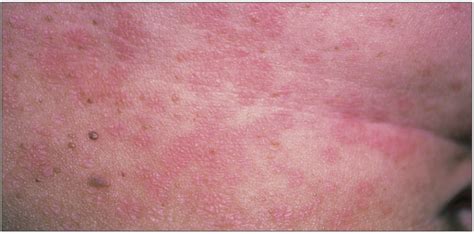 How would you treat this pruritic rash? | Consultant360