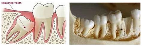 Wisdom Tooth Surgery, Restorative Dentistry, डेंटल ट्रीटमेंट सर्विस in New Delhi , All Smiles ...