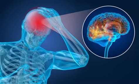 Myths About Concussions Advance Er Dallas Tx