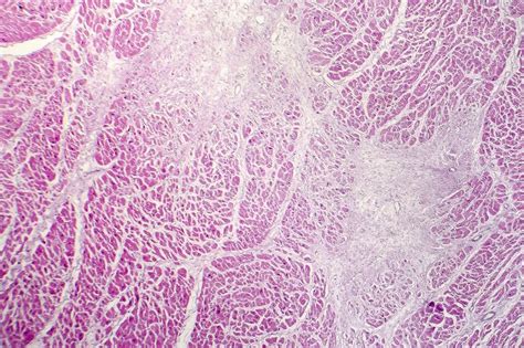 Acute Myocardial Infarction Histology Of Heart Tissue Light