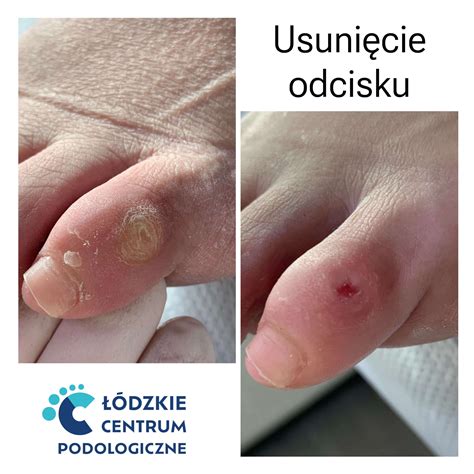 Usunięcie odcisków Łódzkie Centrum Podologiczne