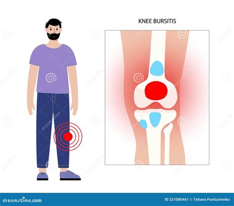 Knee Bursitis Condition With Fluid Filled Bursa In Leg Joint Outline